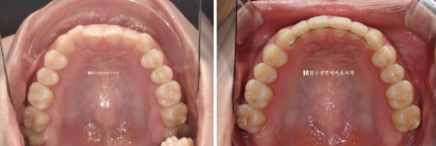 If Inward-Tilted Teeth Make Your Smile Look Constricted? Invisalign Before and After image 13