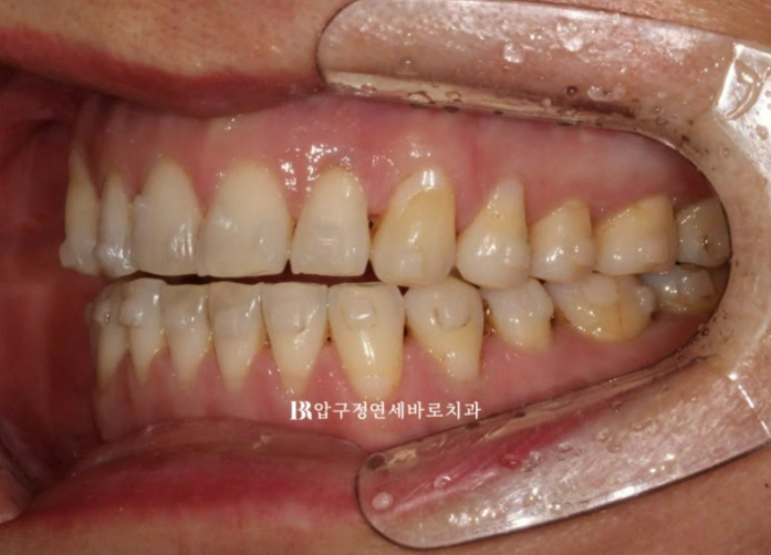 50대 인비절라인 함입 교정 후기 관련 이미지 12