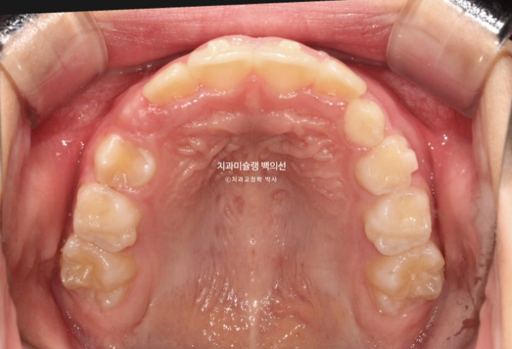 어린이 무턱 성장교정 덧니 인비절라인 퍼스트 악궁확장 치료기간 2년 관련 이미지 20
