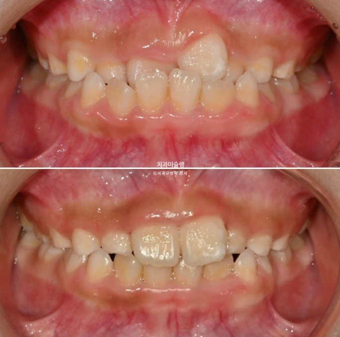7세 어린이 반대교합 부정교합 프리올소 치료 관련 이미지 9
