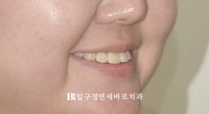 인비절라인라이트 재교정 뻐드렁니 교정 돌출 교정 관련 이미지 3