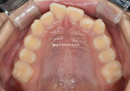 어린이 교정 인비절라인 덧니 치료 후기 관련 이미지 4