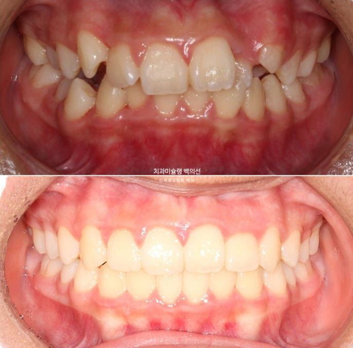 덧니 반대교합 과개교합 인비절라인 퍼스트 악궁확장 어린이 교정 치료 관련 이미지 1