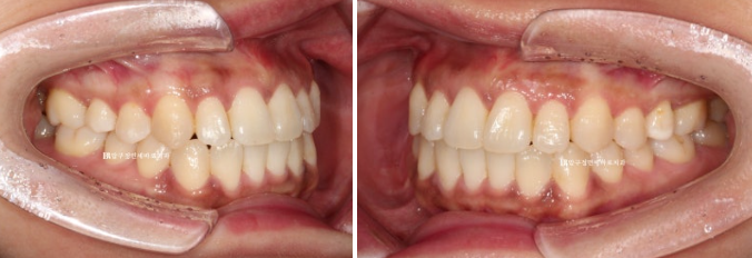 Is compliance important for Invisalign? | A real case that improved reverse bite and scissors bite in 8 months image 11