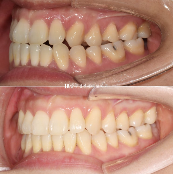 Is Invisalign Treatment Possible After Double-Jaw Surgery? A Real One-Year Case of Surgery-First Orthodontic Treatment image 13