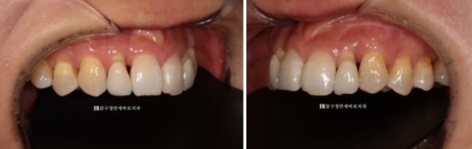 40대 오래된 크라운 교체 / 블랙트라이앵글 젤라미 치료 결과 관련 이미지 2