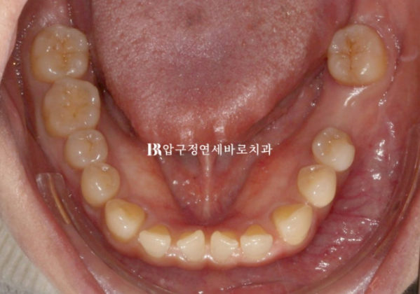 벌어진 앞니, 바로 라미네이트 하지 않은 이유｜인비절라인 후 무삭제 라미네이트 실제 사례 관련 이미지 6