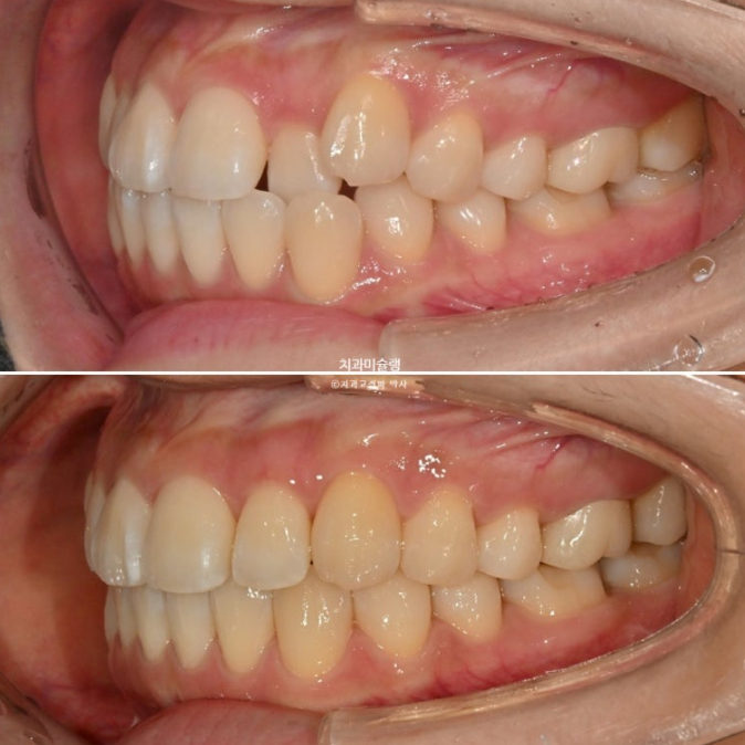 인비절라인 라이트 반대교합? 덧니 중심선 치간삭제 치료 관련 이미지 17