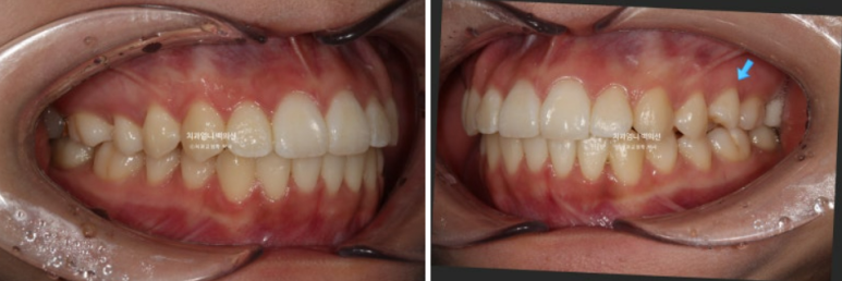 앞니 부분 교정 토끼이빨 덧니교정 ? 관련 이미지 11