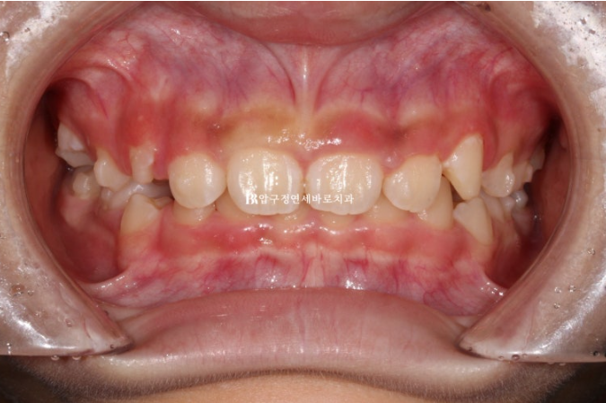 Pediatric Clear Aligners That Improved Both Deep Bite and Protruding Teeth image 6