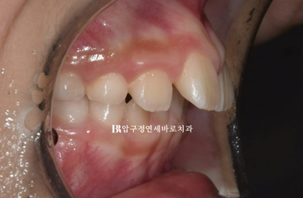 어린이 무턱교정 인비절라인 퍼스트 실제 치료 후기 관련 이미지 3