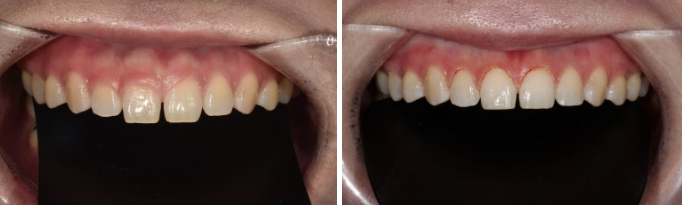 Four No-Prep Veneers for Dwarf Teeth and Conical Front Teeth image 5