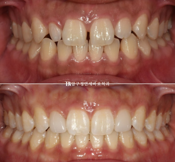 왜소치 인비절라인 라이트 교정 / 무삭제 라미네이트 젤라미 관련 이미지 10