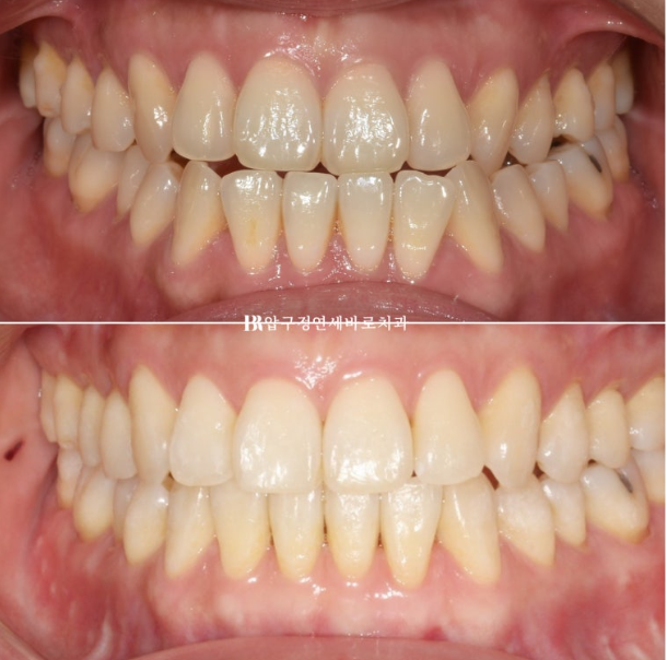 양악수술 선수술 교정 후기 인비절라인 교정 관련 이미지 13