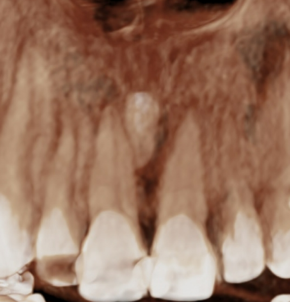 40대 인비절라인 라이트 과개교합 과잉치 덧니 교정 임플란트 보철 교정 후기 관련 이미지 8