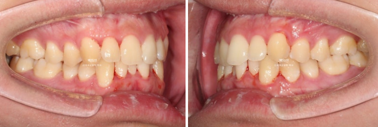 유학생 교정 인비절라인 라이트 치료기간 5개월 관련 이미지 3