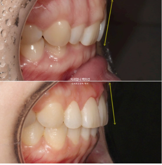 Inward-Tilted Teeth Orthodontic Treatment Review | Actual Case Improved with Non-Extraction Orthodontic Treatment for Gummy Smile, Deep Overbite & Gum Asymmetry — Gangnam Orthodontic Clinic image 17
