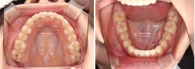중학생 주걱턱 반대교합 개방교합 덧니 교정 인비절라인 후기 관련 이미지 9