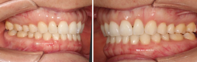 인비절라인 라이트 가위교합 벌어짐 중심선 미니스크류 치료기간 11개월 관련 이미지 9