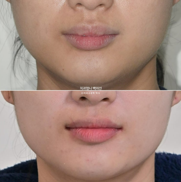 인비절라인으로 발치교정이 가능할까요? 돌출입&middot;과개교합 발치교정 증례 관련 이미지 19