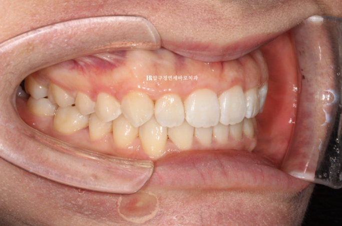 인비절라인 라이트 과개교합 반대교합 돌출입 뻐드렁니 교정 치료 관련 이미지 13
