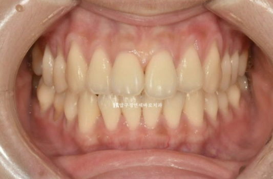 인비절라인 익스프레스 토끼이빨 앞니교정 ? 관련 이미지 2