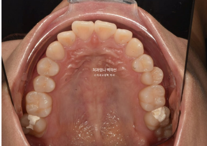 앞니 부분 교정 급속 교정 토끼이빨 MTA 미니튜브 치간삭제 치료기간 9개월 관련 이미지 5