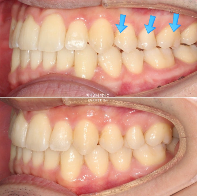 인비절라인 비발치 앞니 돌출 교정 치료기간 2년 5개월 관련 이미지 13