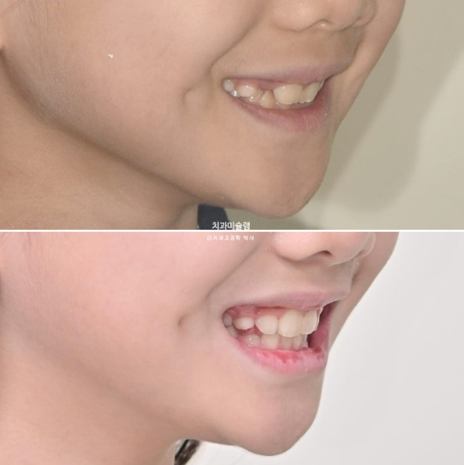어린이 투명교정 인비절라인 퍼스트 과개교합 교정 후기 관련 이미지 24