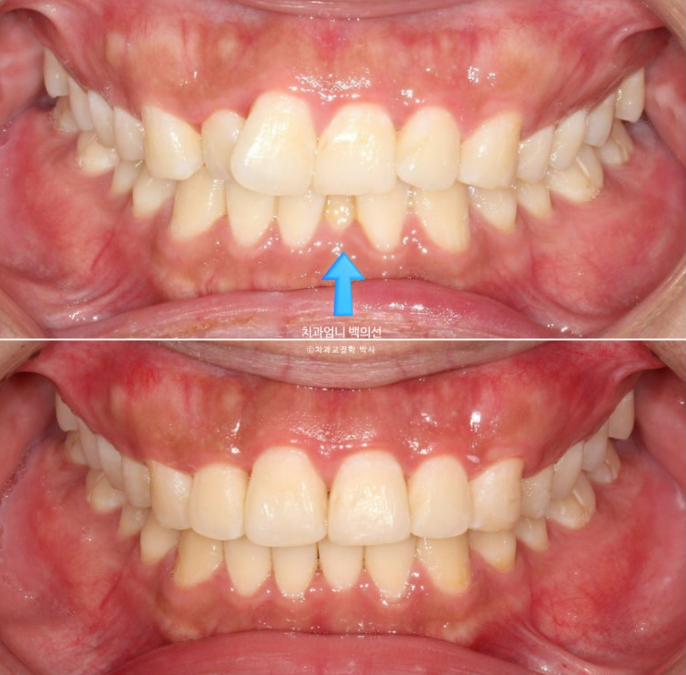 앞니 부분교정 덧니 교정 블랙트라이앵글 부정교합 마모 시뮬레이션 치료기간 5개월 관련 이미지 14