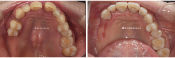 A 60s Patient’s Orthodontic Treatment Review | A Case Combining Partial Orthodontics for the Front Teeth After Periodontitis Treatment with No-Prep Veneers image 10