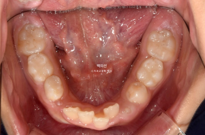 인비절라인퍼스트 어린이 투명교정 과개교합 덧니 악궁확장 돌출 관련 이미지 5