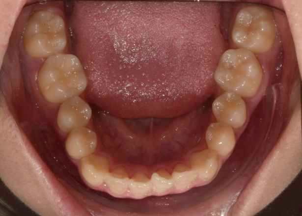 유학생 교정 덧니 반대교합 인비절라인 라이트 치료기간 관련 이미지 5