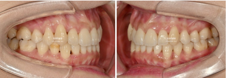 인비절라인 비발치 제2대구치 발치 사랑니 대체 교정 심한 덧니 교정 치료 관련 이미지 18