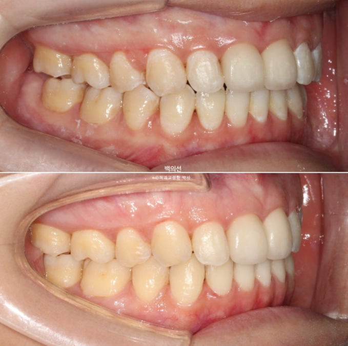 클리피씨 교정에서 인비절라인 변경 마무리 인비절라인 라이트 치료기간 4개월 관련 이미지 13