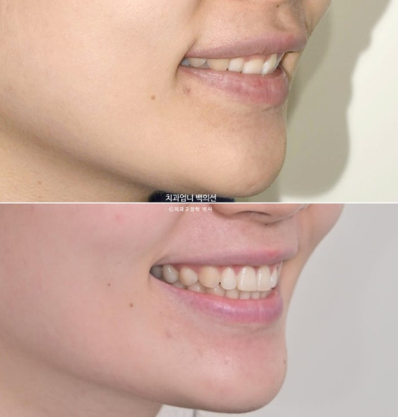 거미스마일 과개교합 교정 잇몸돌출 잇몸 비대칭 관련 이미지 20