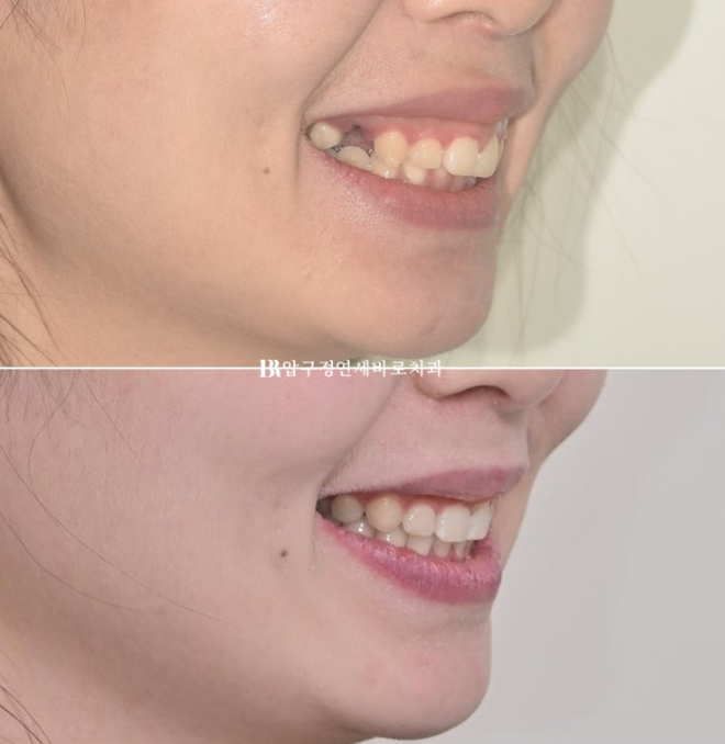 인비절라인 돌출입 발치교정 거미스마일 잇몸미소 교정 관련 이미지 14