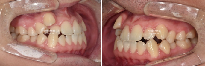 투명교정 인비절라인 덧니 교정 치료기간 알아보기 관련 이미지 3