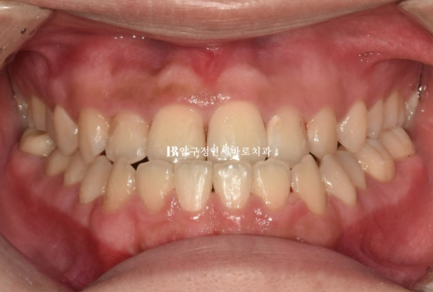 양악수술 교정 인비절라인 주걱턱 교정 치료 후기 관련 이미지 2