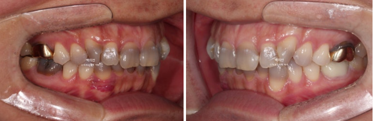 Treatment Review: No-Prep Laminate for Tetracycline-Stained Teeth image 5