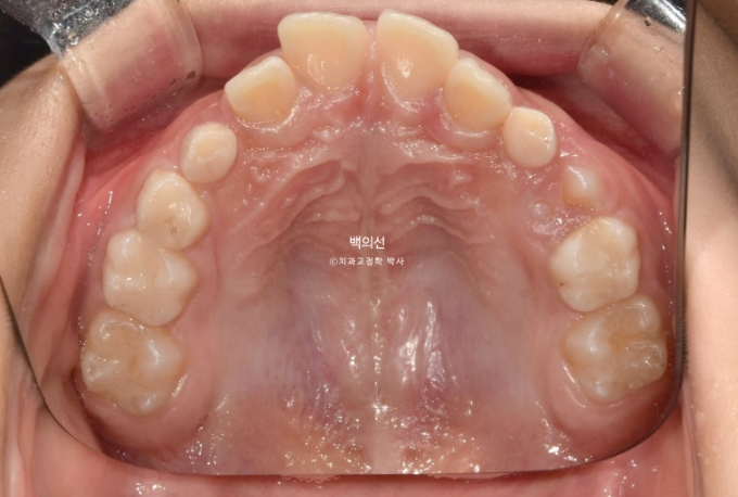 인비절라인퍼스트 어린이 투명교정 과개교합 덧니 악궁확장 돌출 관련 이미지 4