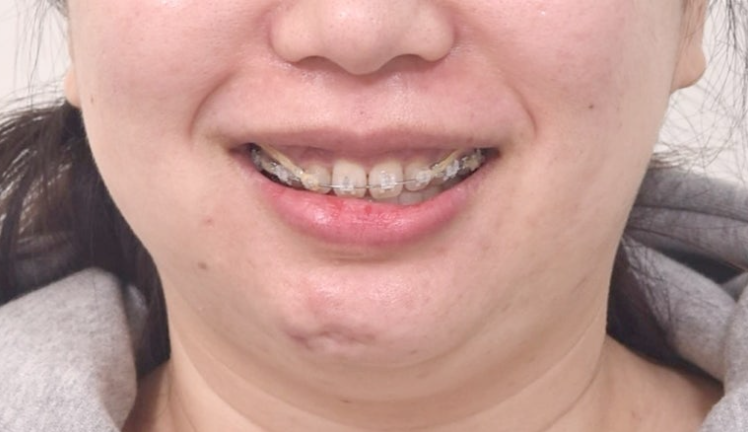 Extraction Orthodontics with Clippy-C for Protruding Mouth, Gum Smile, Gummy Smile Correction, and Treatment for a Recessed Chin image 8