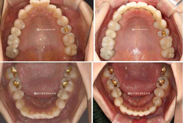 Gangnam Orthodontic Clinic: A Woman in Her 30s’ Rabbit Teeth Correction Review|Six-Month Front Teeth Partial Orthodontic Treatment That Also Improved a Crossbite image 9