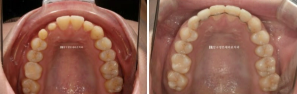 왜소치 치료 잔존유치 무삭제 라미네이트 후기 관련 이미지 10