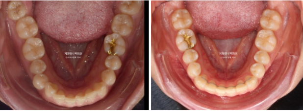 Inward-Tilted Teeth Orthodontic Treatment Review | Actual Case Improved with Non-Extraction Orthodontic Treatment for Gummy Smile, Deep Overbite & Gum Asymmetry — Gangnam Orthodontic Clinic image 13
