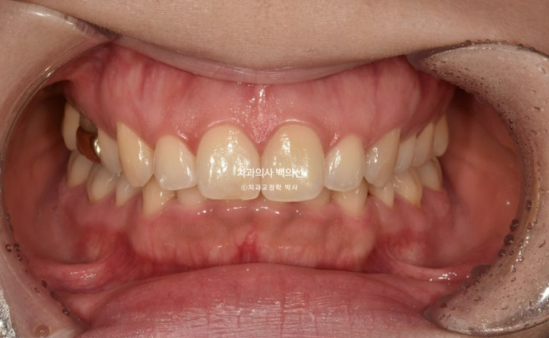 인비절라인 라이트 재교정 발치공간 벌어짐 ? 관련 이미지 1