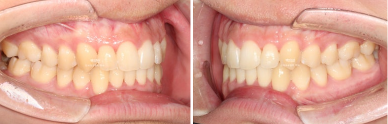 유학생 교정 인비절라인 라이트 치료기간 5개월 관련 이미지 10