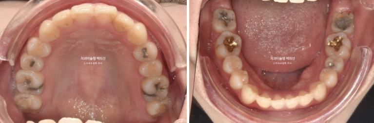 돌출입 인비절라인 발치교정 거미스마일 잇몸미소 잇몸돌출 입술부전증 무턱 재교정 관련 이미지 4