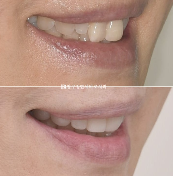 50s Invisalign Lite No-Prep Laminate Bunny Teeth image 17