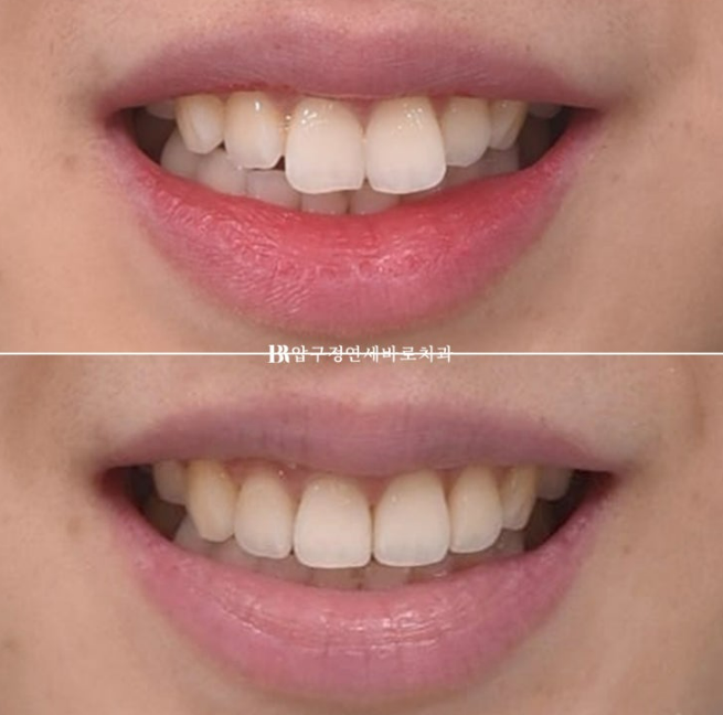 Can Rabbit Teeth Be Corrected? 5-Month Real Case of Butterfly Teeth Anterior Partial Orthodontic Treatment image 1